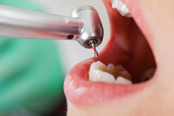 Best Emergency Tooth Extraction in Lake Odessa, MI